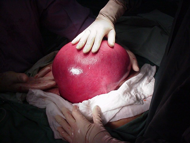 large fibroid uterus dr youssif large fibroid uterus dr youssif